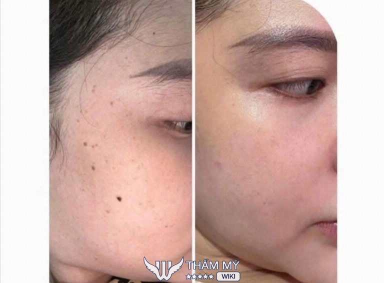 Địa chỉ tẩy nốt ruồi ở Thủ Đức - Thẩm mỹ viện Sala