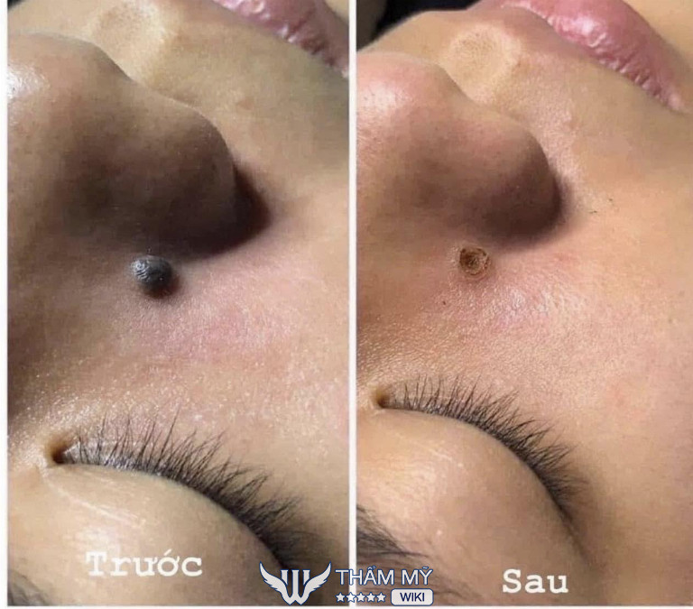 Ox Spa xóa nốt ruồi ở Thủ Đức