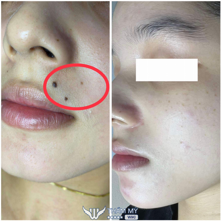 Thẩm Mỹ Châu Pha - Địa chỉ tẩy nốt ruồi ở Thủ Đức