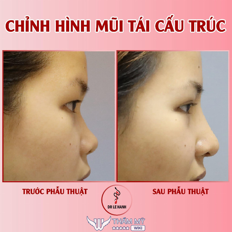 Nâng mũi tại PGS.TS.BS Lê Hành