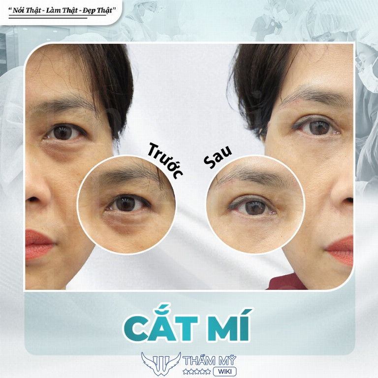 Thẩm mỹ mắt tại PGS.TS.BS Phạm Hiếu Liêm
