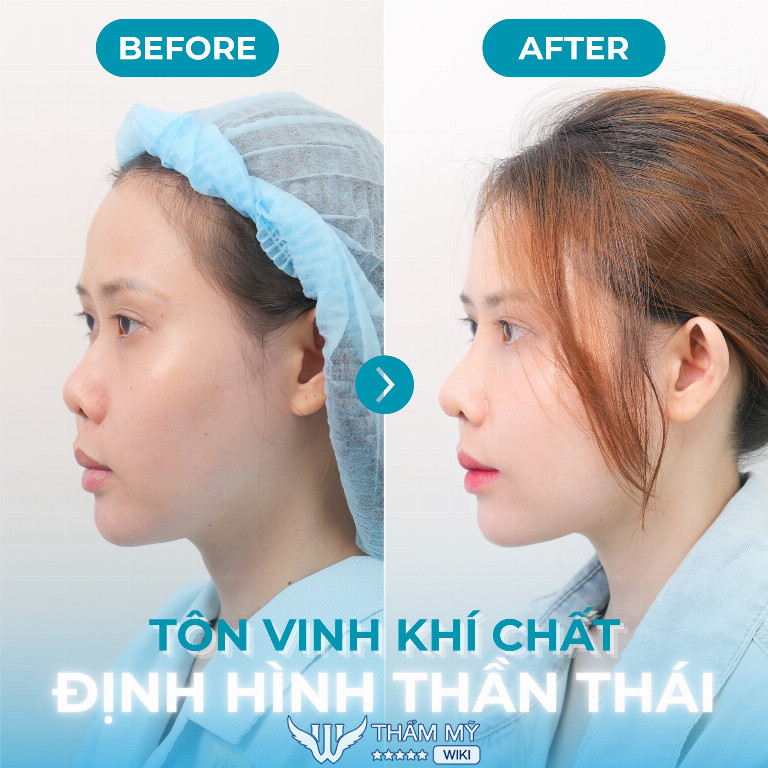 nâng mũi tại PGS.TS.BS Trần Đăng Khoa