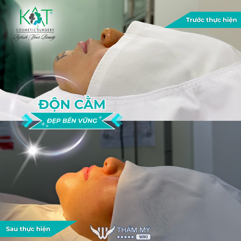 Độn cằm tại phòng khám thẩm mỹ PGS.TS.BS Trần Đăng Khoa