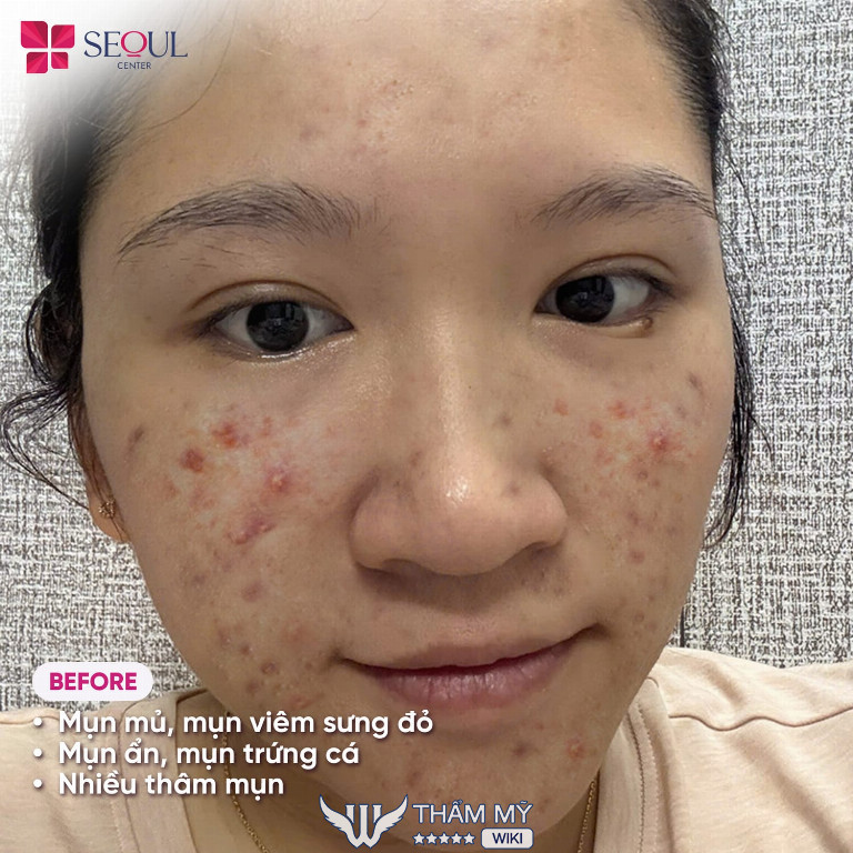 địa chỉ trị mụn ở Bình Dương - Seoul Spa 