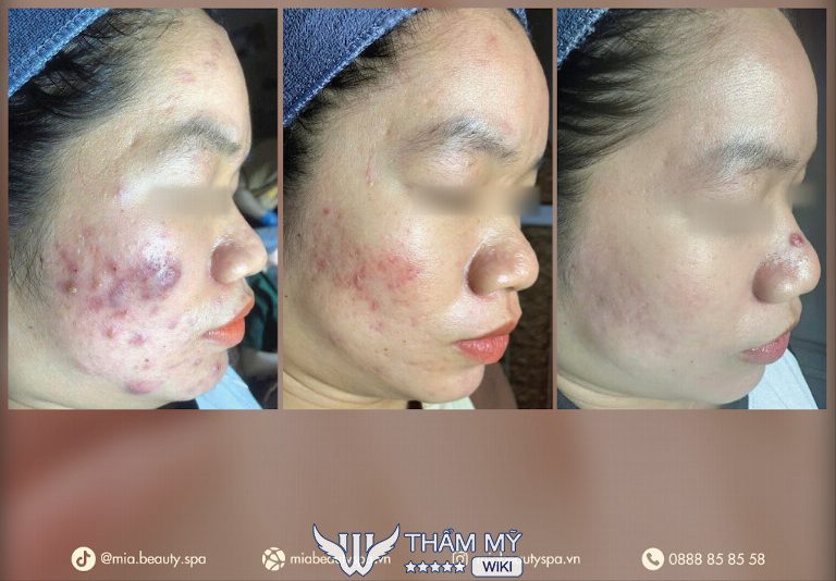 MiA Beauty Spa trị mụn tốt nhất ở Bình Dương
