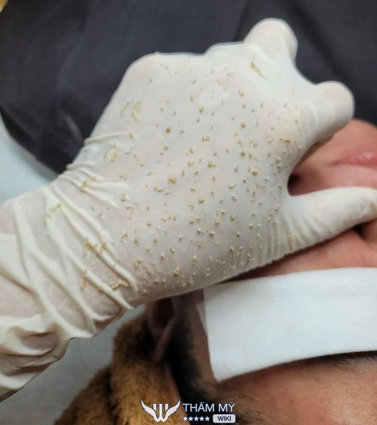 Spa Uyên Vy trị mụn ở Bình Dương