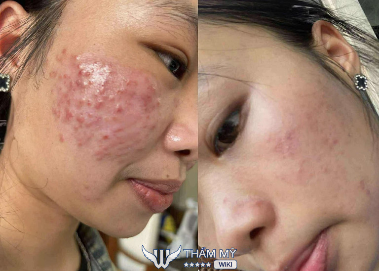 Lucie Beauty Spa spa trị mụn tại Bình Dương