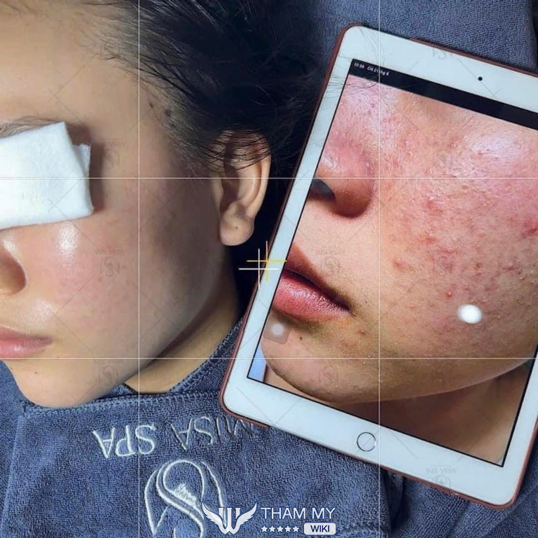 Misa Spa điều trị mụn ở Nha Trang