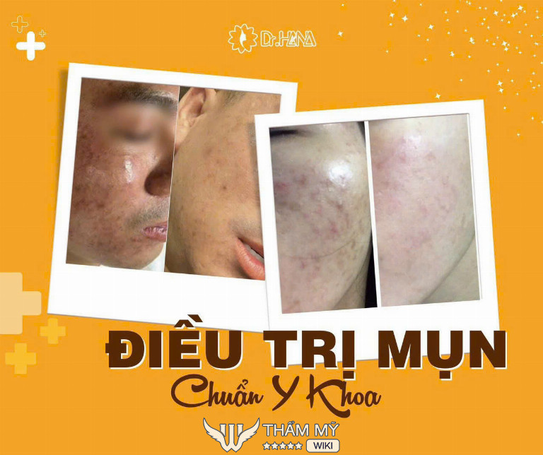 Hana Spa trị mụn Vũng Tàu