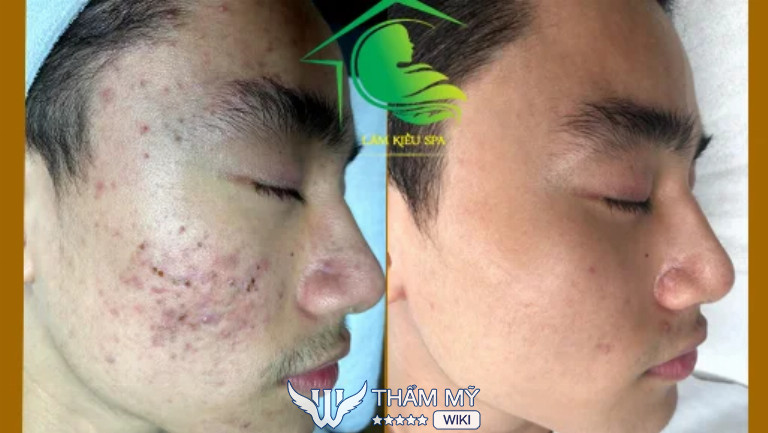 Lâm Kiều Spa trị mụn tại Vũng Tàu