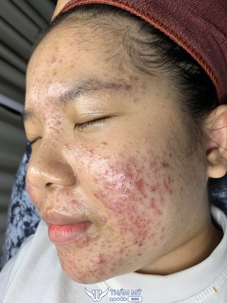 Trà Ny Spa trị mụn ở Vũng Tàu