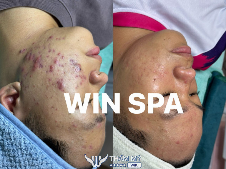 Win Spa trị mụn ở Vũng Tàu