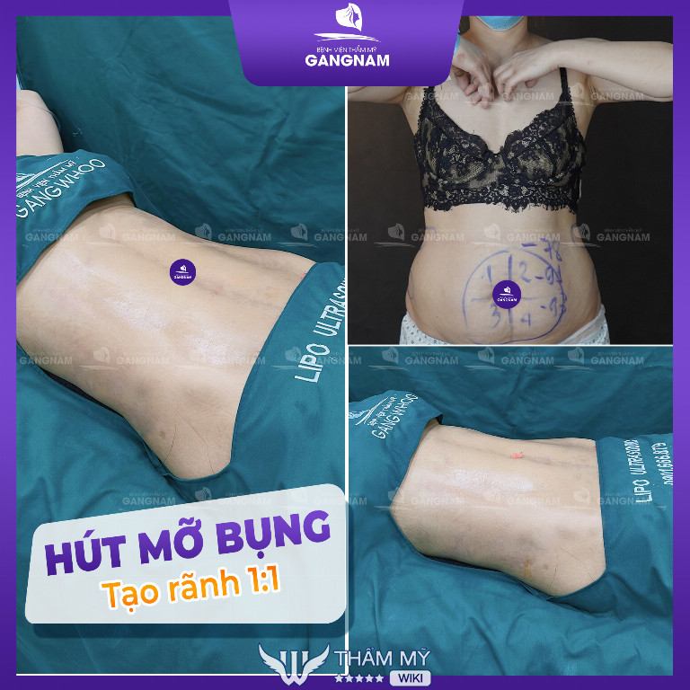 dịch vụ hút mỡ bụng tại Thẩm Mỹ Viện Gangnam gây chết người lừa đảo