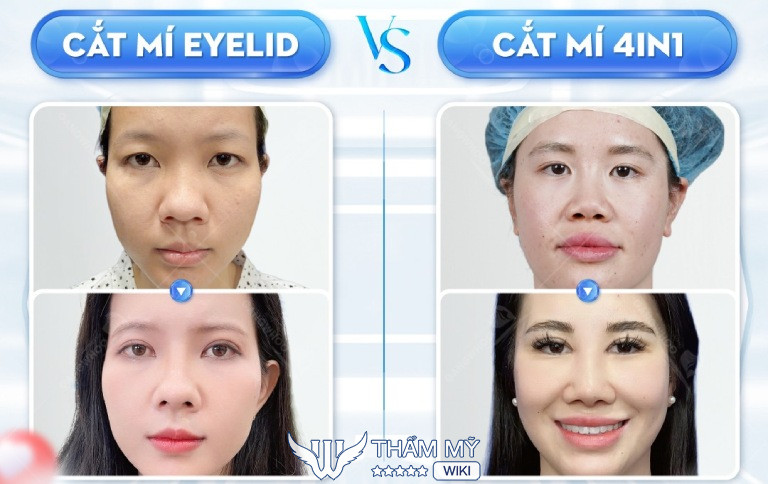 Thẩm mỹ mắt tại Thẩm Mỹ Viện Gangwhoo