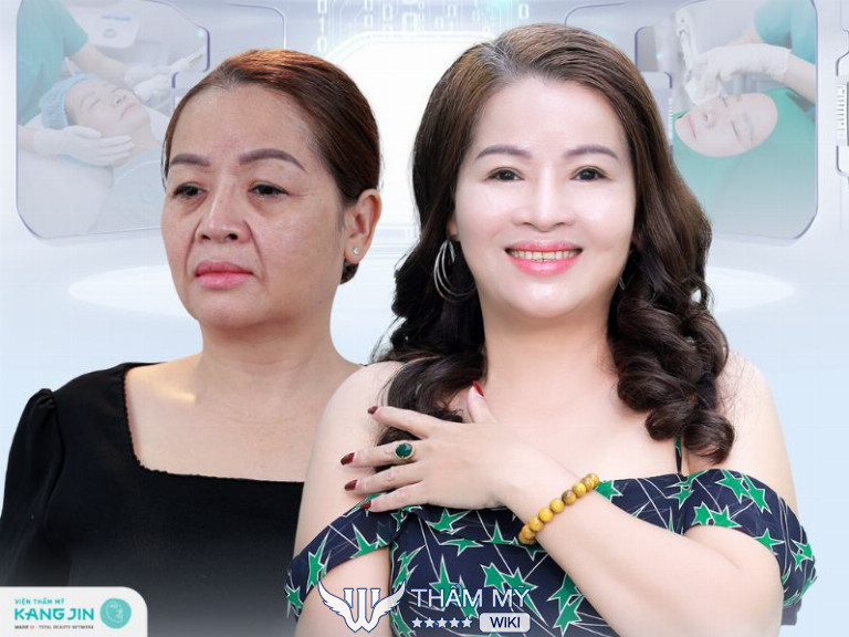 Địa chỉ căng da mặt bằng chỉ tại TPHCM uy tín - Viện thẩm mỹ KangJin