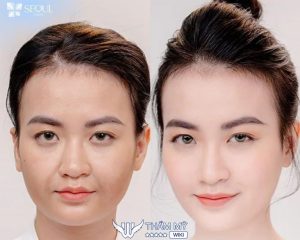 5 Địa chỉ căng da mặt bằng chỉ tại TPHCM uy tín, chất lượng