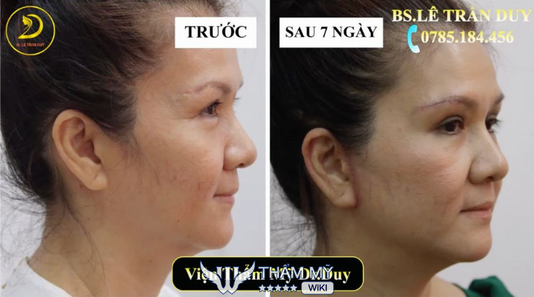 Địa chỉ căng da mặt tại TPHCM đẹp và uy tín - Thẩm mỹ Galaxy