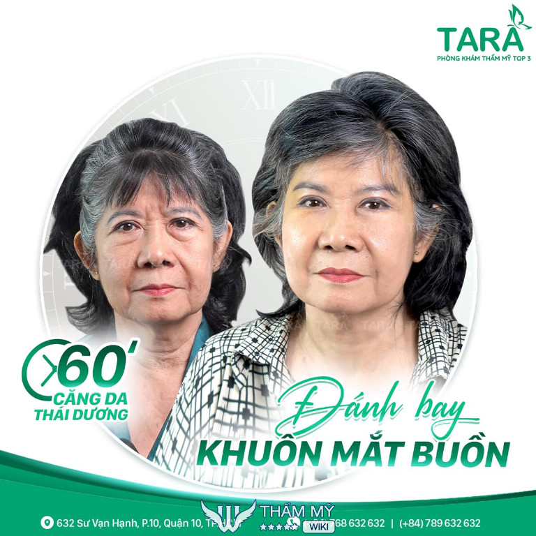 Phẫu thuật căng da mặt tại TPHCM - TARA Beauty Clinic