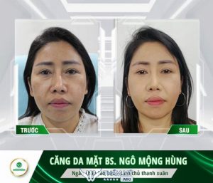 10 Địa chỉ căng da mặt tại TPHCM đẹp, an toàn & uy tín