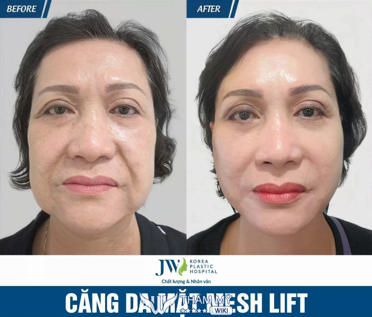 Địa chỉ phẫu thuật căng da mặt tại TPHCM uy tín - Bệnh viện thẩm mỹ JW Hàn Quốc