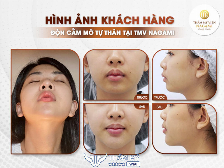 Địa chỉ độn cằm đẹp, uy tín tại Hà Nội - Thẩm Mỹ Viện Nagami