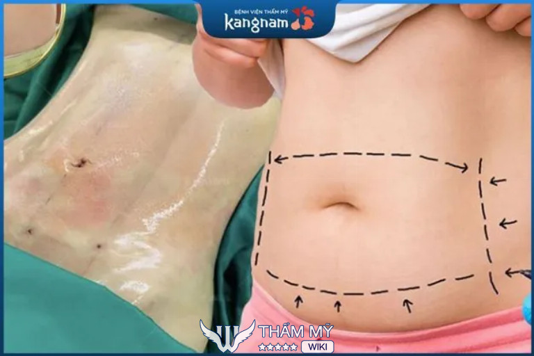 Địa chỉ hút mỡ bụng uy tín, chất lượng ở Hà Nội - Bệnh viện thẩm mỹ Kangnam