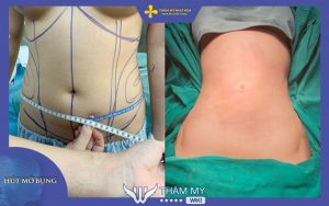 10 Địa chỉ hút mỡ bụng ở Hà Nội uy tín và chất lượng