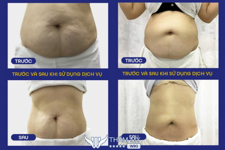 Địa chỉ hút mỡ bụng chất lượng tại Hà Nội - Thẩm mỹ viện Ngọc Dung