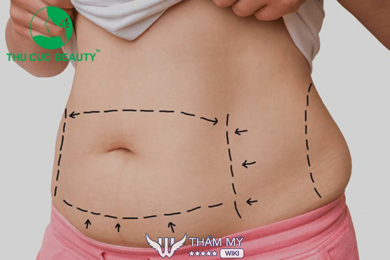 Hút mỡ bụng tại Hà Nội - Bệnh viện thẩm mỹ Thu Cúc