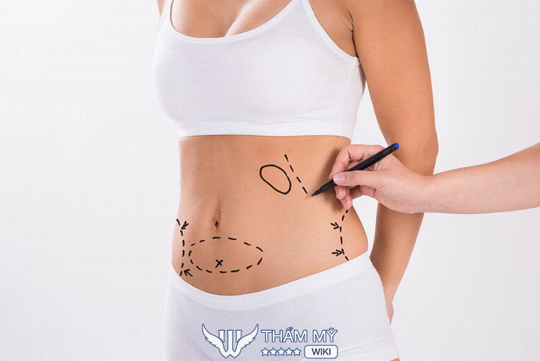 Địa chỉ hút mỡ bụng tại Sài Gòn uy tín - Viện thẩm mỹ FV – Lifestyle