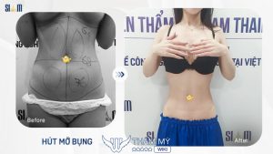10 Địa chỉ hút mỡ giảm béo toàn thân tại TPHCM uy tín
