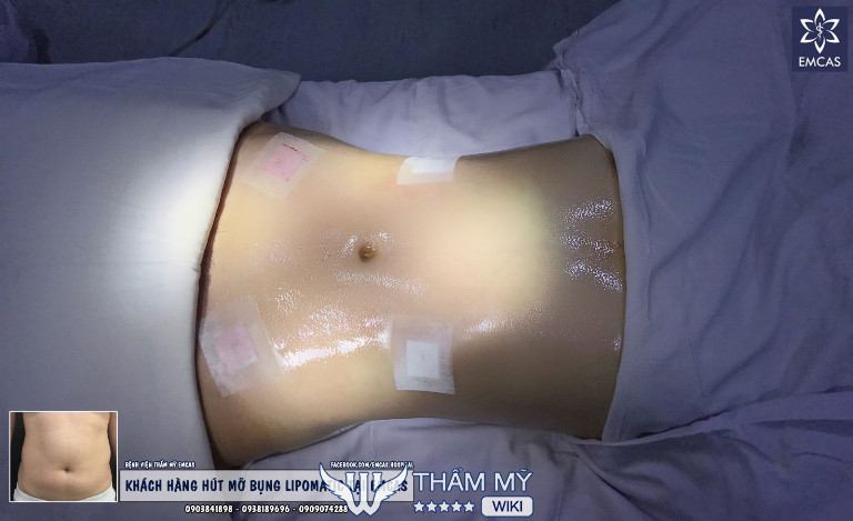 Địa chỉ hút mỡ toàn thân tại TPHCM uy tín, chất lượng - Bệnh viện thẩm mỹ Emcas