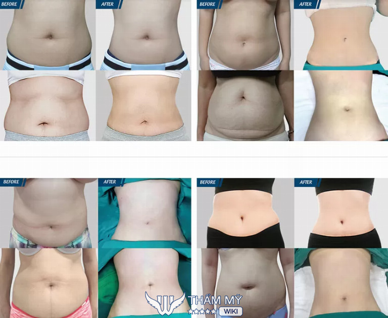 Địa chỉ hút mỡ giảm béo toàn thân tại TPHCM tốt - Bệnh viện thẩm mỹ JW Hàn Quốc