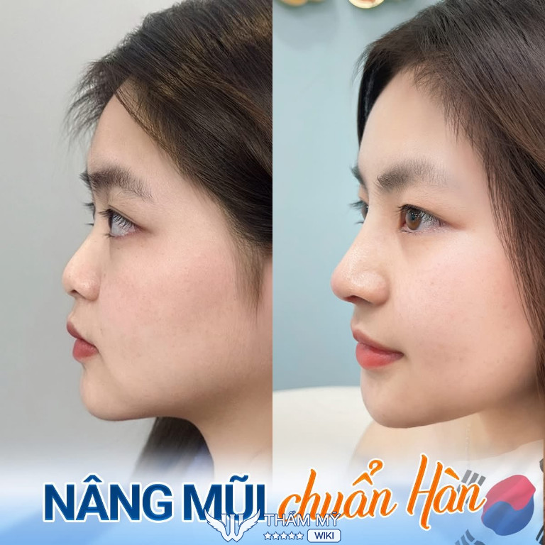 Địa chỉ nâng mũi tại Hà Nội đẹp và uy tín - Bệnh viện thẩm mỹ Kangnam