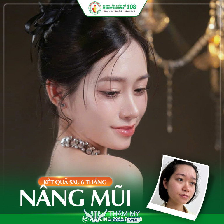 Địa chỉ nâng mũi đẹp, an toàn tại Hà Nội - Bệnh viện 108