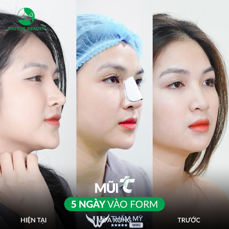 Địa chỉ nâng mũi tại TPHCM nổi tiếng - Bệnh viện thẩm mỹ Thu Cúc