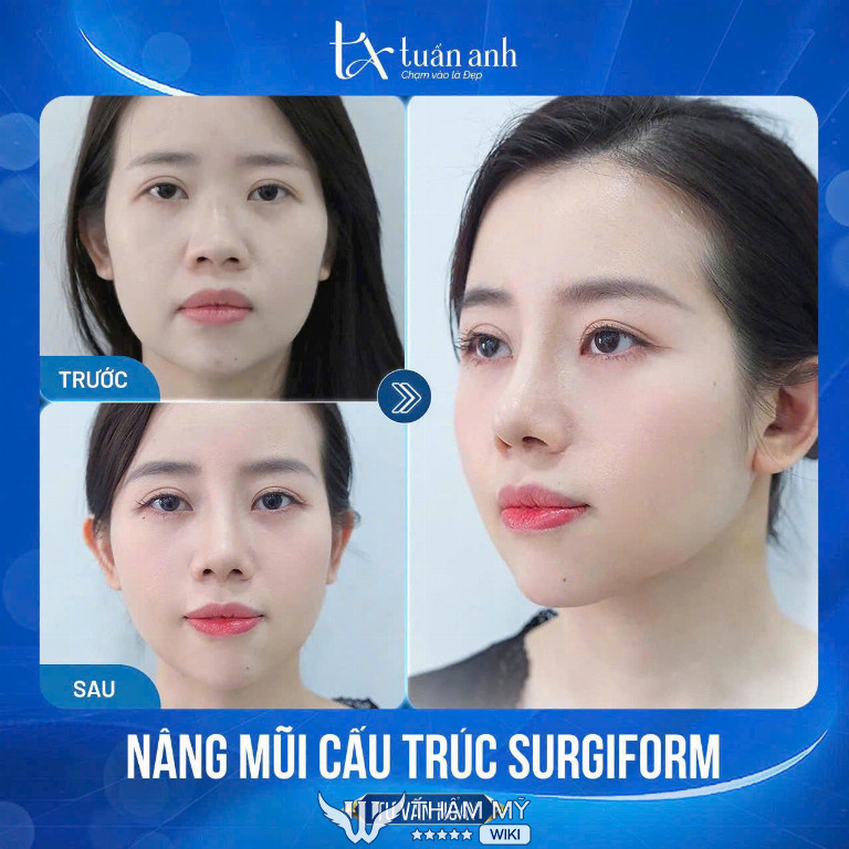 Địa chỉ nâng mũi tại Hà Nội uy tín, làm đẹp - Thẩm mỹ Tuấn Anh