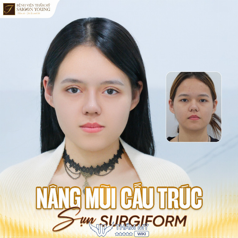 Địa chỉ nâng mũi uy tín ở Hà Nội - Thẩm mỹ viện Saigon Young