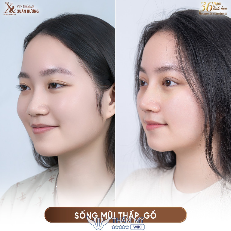 Địa chỉ làm mũi đẹp tại Hà Nội - Viện thẩm mỹ Xuân Hương