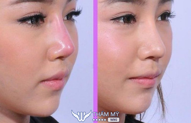 Sửa mũi hỏng ở đâu đẹp, an toàn tại TPHCM? Thẩm mỹ viện Tấm