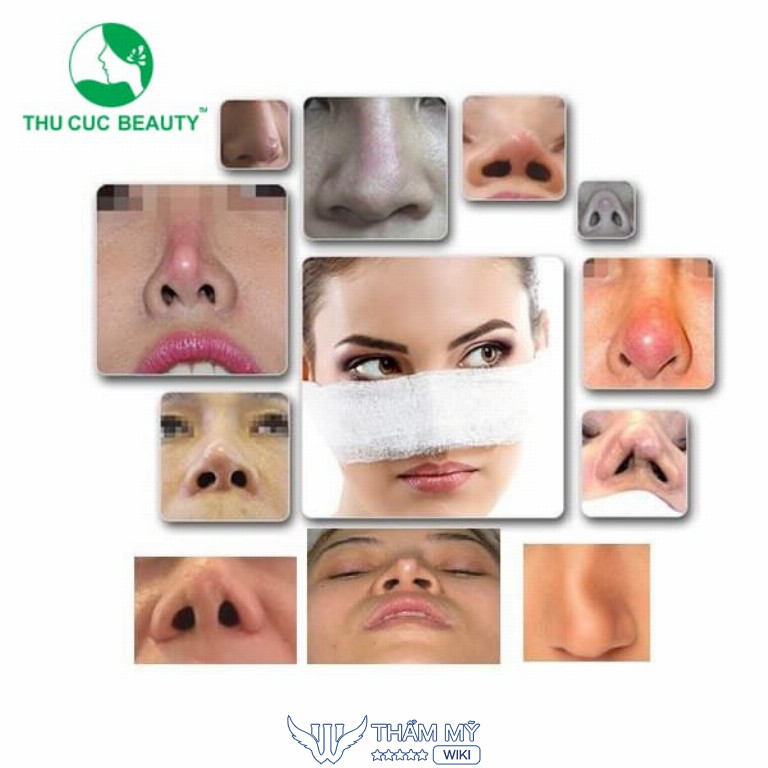 Chỉnh sửa mũi hỏng tại TPHCM - Bệnh viện thẩm mỹ Thu Cúc