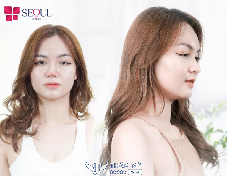 Địa chỉ chỉnh sửa mũi hỏng uy tín tại TPHCM - Thẩm mỹ viện Seoul Center