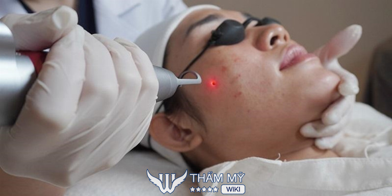 Địa chỉ tẩy nốt ruồi ở Thanh Hóa - Bệnh viện Da liễu Thanh Hóa 