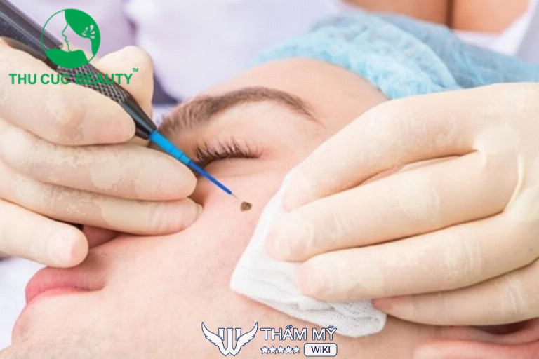 Địa chỉ tẩy nốt ruồi ở Thanh Hóa - Thu Cúc Clinics