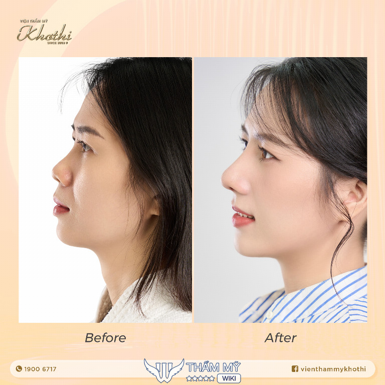 Địa chỉ thu gọn cánh mũi tại TPHCM uy tín - Viện thẩm mỹ Khơ Thị