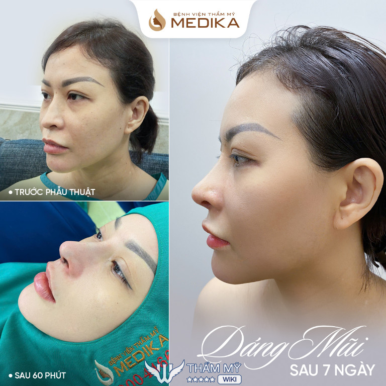 Thu gọn cánh mũi ở đâu đẹp tại TPHCM? Bệnh viện thẩm mỹ Medika