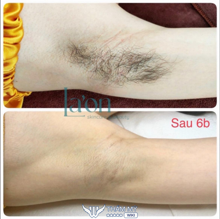 Địa chỉ triệt lông ở Quận 1 giá rẻ - La’on Skincare & Beauty
