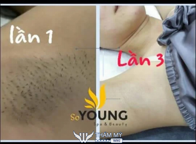 SoYoung Spa là Địa chỉ triệt lông tại Quận 1 
