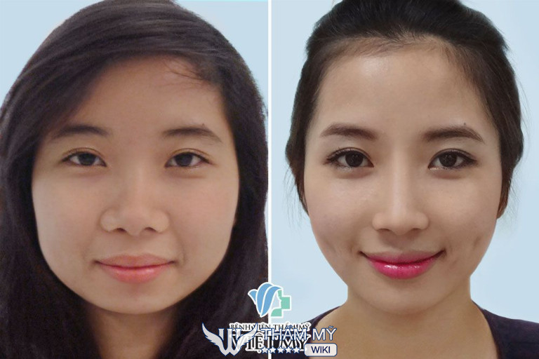 Địa chỉ làm má lúm đồng tiền đẹp tại TPHCM - Bệnh viện Thẩm mỹ Việt Mỹ