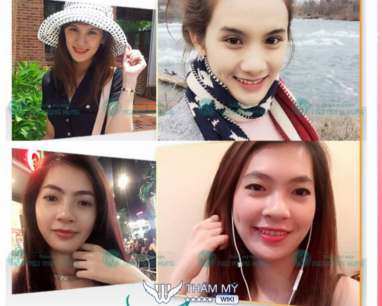 Địa chỉ làm má lúm đồng tiền ở TPHCM đẹp - Bệnh viện thẩm mỹ Ngô Mộng Hùng